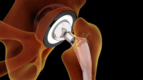  Titanium: De Metaalkoning voor Biocompatibiliteit en Duurzaamheid!