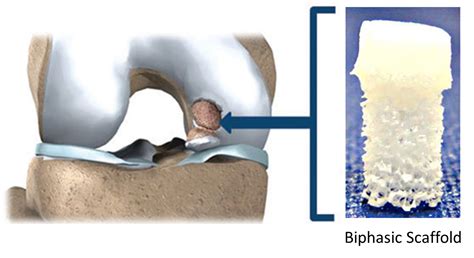  Osteochondraal - Een Kneedbare Revolutie in Regeneeratieve Geneeskunde?