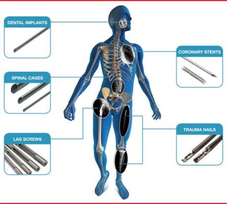  Titanium: Hoge Sterkte Met Biocompatibiliteit Voor Medische Implantaten!